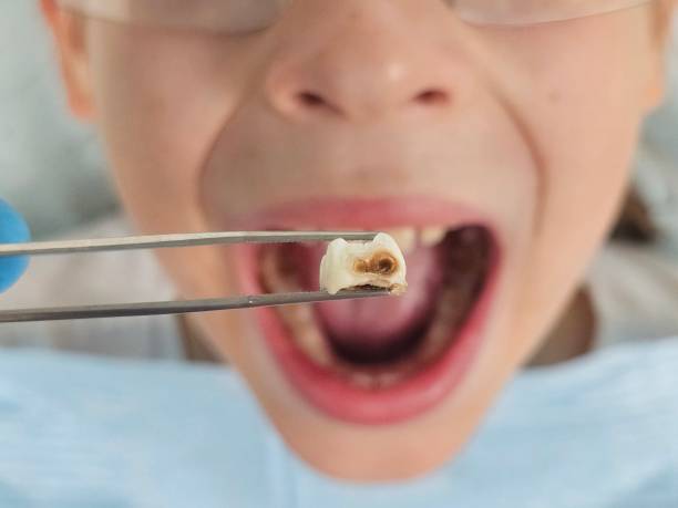 Best Emergency Tooth Extraction in Embreeville, TN